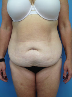 Tummy Tuck (Abdominoplasty)