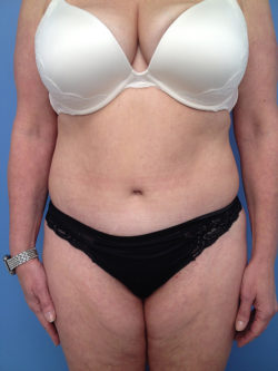 Tummy Tuck (Abdominoplasty)