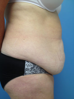 Tummy Tuck (Abdominoplasty)