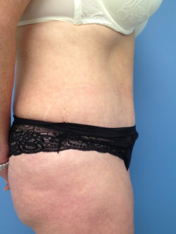 Tummy Tuck (Abdominoplasty)