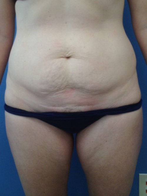 Tummy Tuck (Abdominoplasty) Case 298 Before Photo Tummy Tuck (Abdominoplasty)