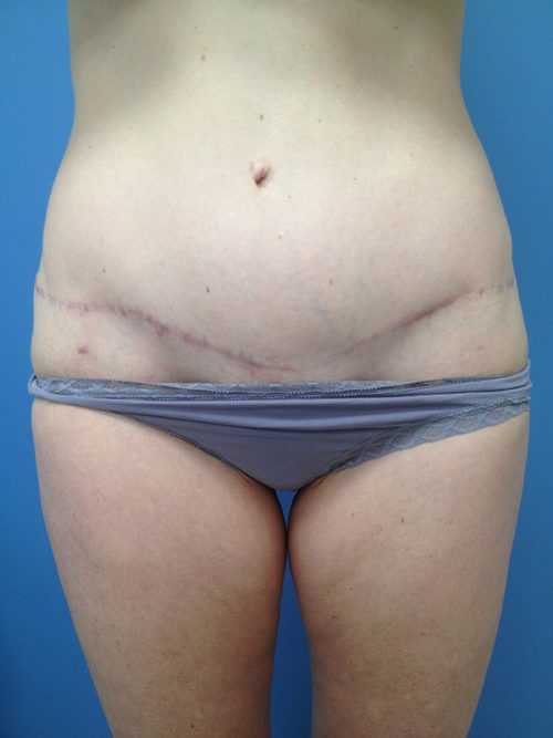 Tummy Tuck (Abdominoplasty) Case 298 After Photo Tummy Tuck (Abdominoplasty)