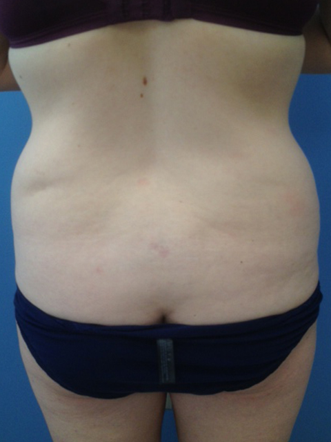 Tummy Tuck (Abdominoplasty)