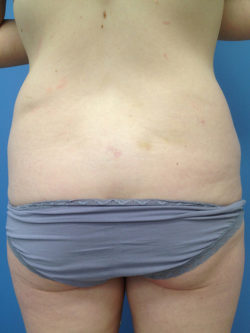 Tummy Tuck (Abdominoplasty)