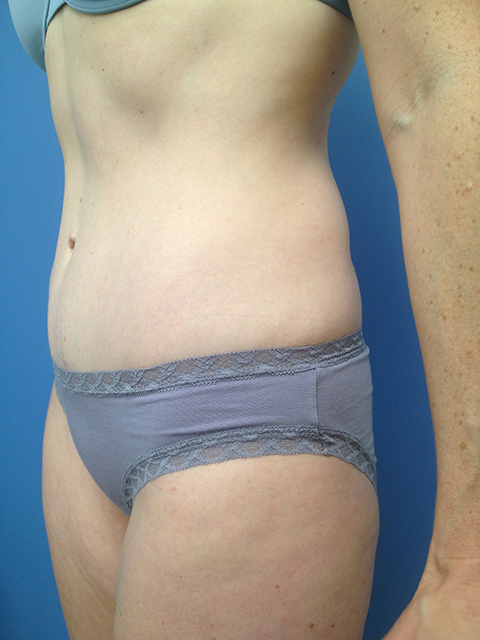 Tummy Tuck (Abdominoplasty) Case 298 After Photo Tummy Tuck (Abdominoplasty)