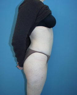 Tummy Tuck (Abdominoplasty)