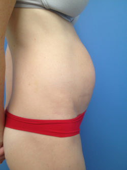 Tummy Tuck (Abdominoplasty)