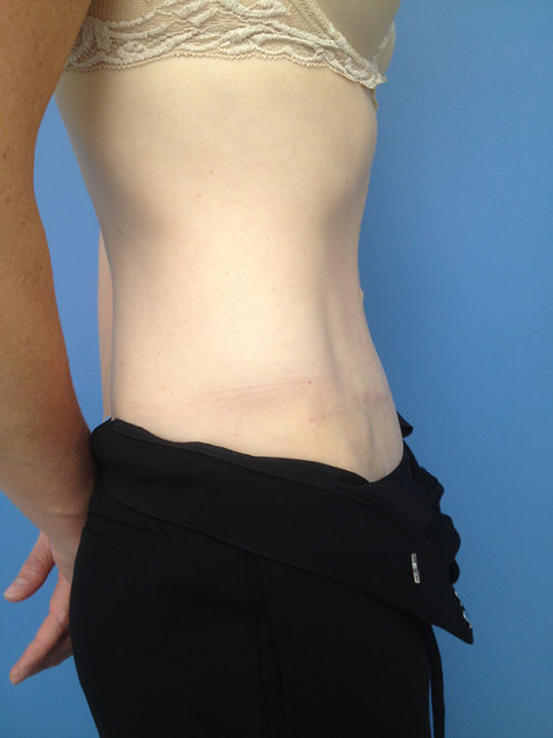 Tummy Tuck (Abdominoplasty)