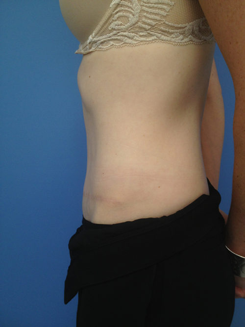 Tummy Tuck (Abdominoplasty) Case 300 After Photo Tummy Tuck (Abdominoplasty)