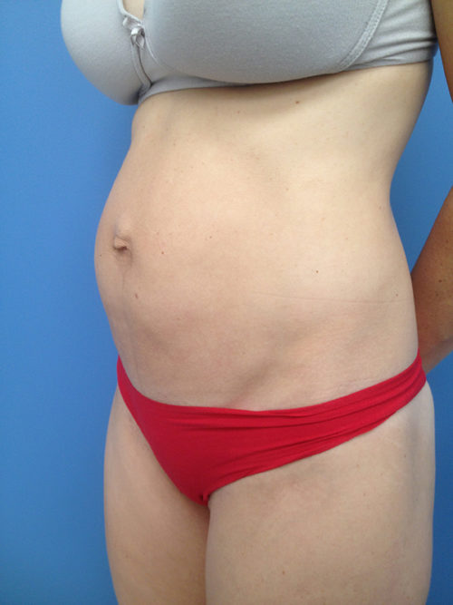 Tummy Tuck (Abdominoplasty)