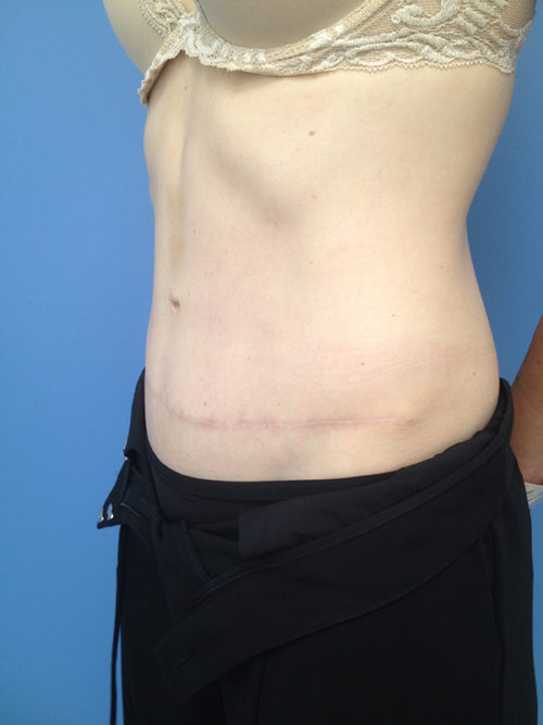 Tummy Tuck (Abdominoplasty)