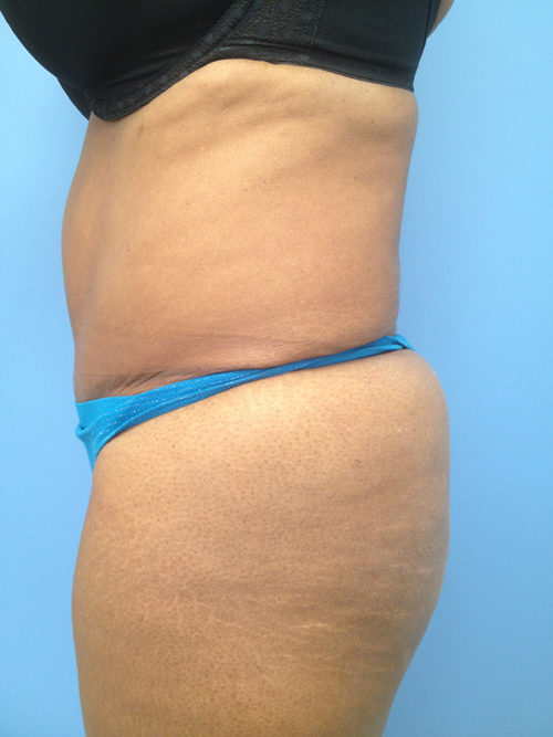 Brazilian Butt Lift Case 301 After Photo Brazilian Butt Lift