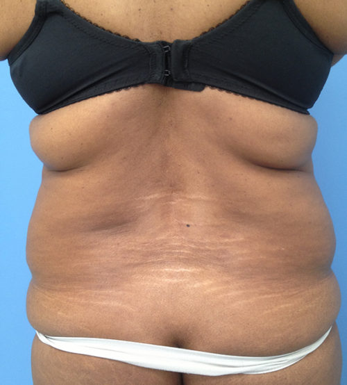 Brazilian Butt Lift Case 301 Before Photo Brazilian Butt Lift