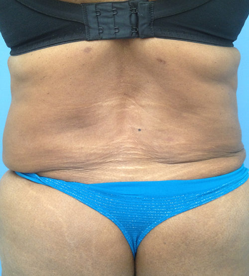 Brazilian Butt Lift Case 301 After Photo Brazilian Butt Lift