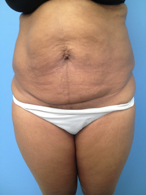Brazilian Butt Lift Case 301 Before Photo Brazilian Butt Lift