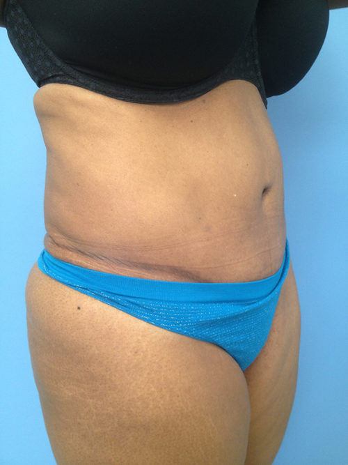 Brazilian Butt Lift Case 301 After Photo Brazilian Butt Lift