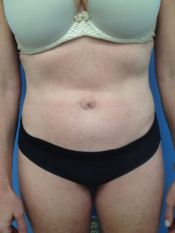 Tummy Tuck (Abdominoplasty)