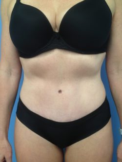 Tummy Tuck (Abdominoplasty)