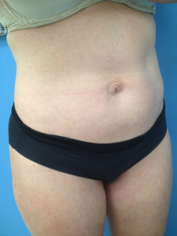 Tummy Tuck (Abdominoplasty)