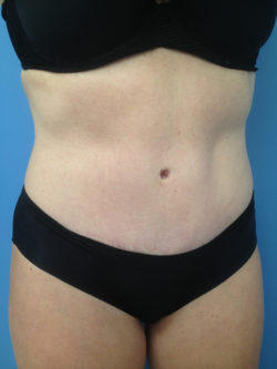 Tummy Tuck (Abdominoplasty)