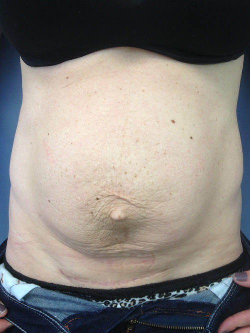 Tummy Tuck (Abdominoplasty) Case 303 Before Photo Tummy Tuck (Abdominoplasty)