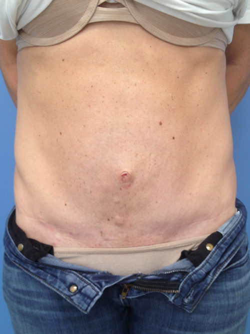 Tummy Tuck (Abdominoplasty) Case 303 After Photo Tummy Tuck (Abdominoplasty)