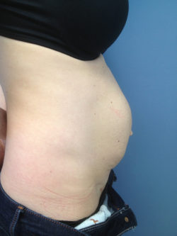 Tummy Tuck (Abdominoplasty)