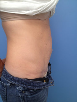 Tummy Tuck (Abdominoplasty)