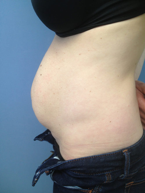 Tummy Tuck (Abdominoplasty) Case 303 Before Photo Tummy Tuck (Abdominoplasty)