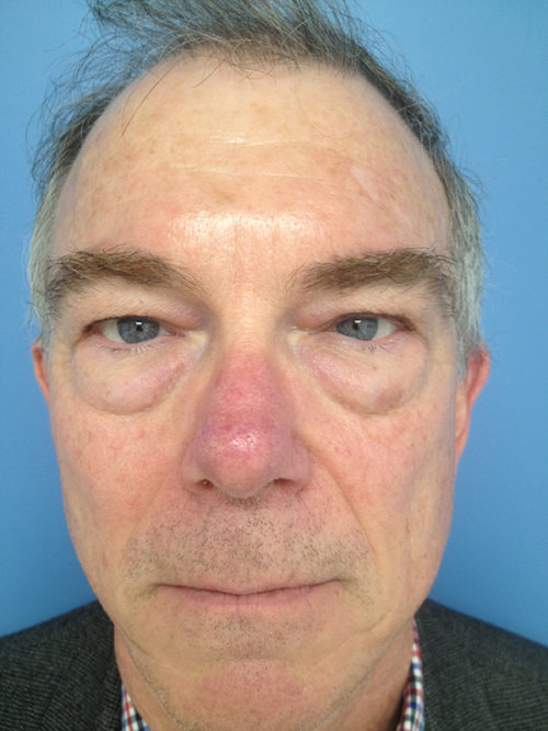 Male Eyelid Surgery Case 379 Before Photo Male Eyelid Surgery