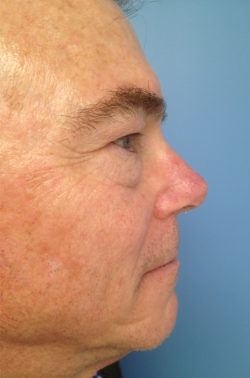 Male Eyelid Surgery