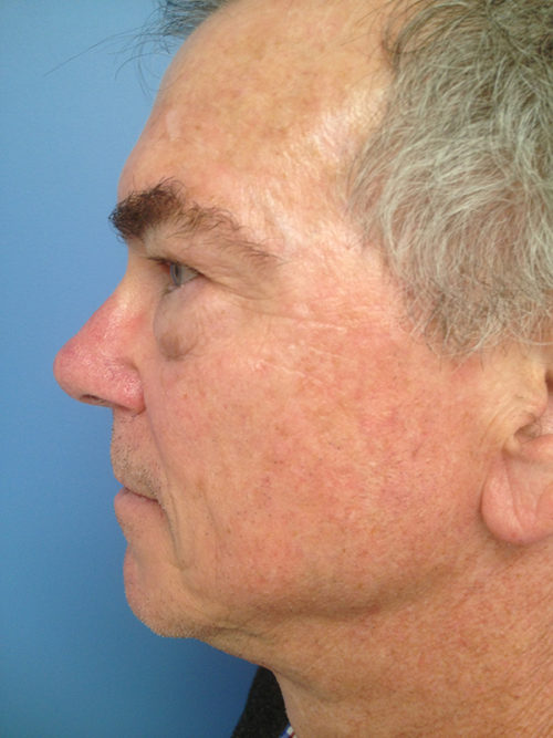 Male Eyelid Surgery Case 379 Before Photo Male Eyelid Surgery