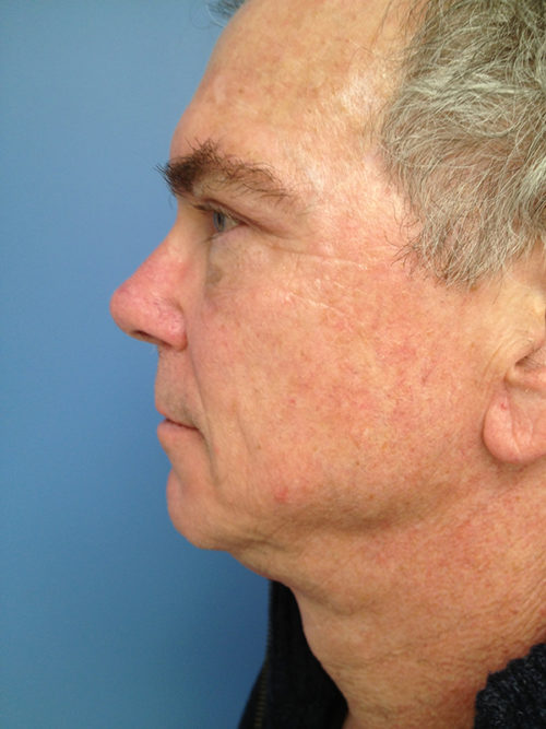 Male Eyelid Surgery Case 379 After Photo Male Eyelid Surgery