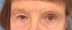 Eyelid Surgery