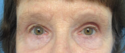 Eyelid Surgery