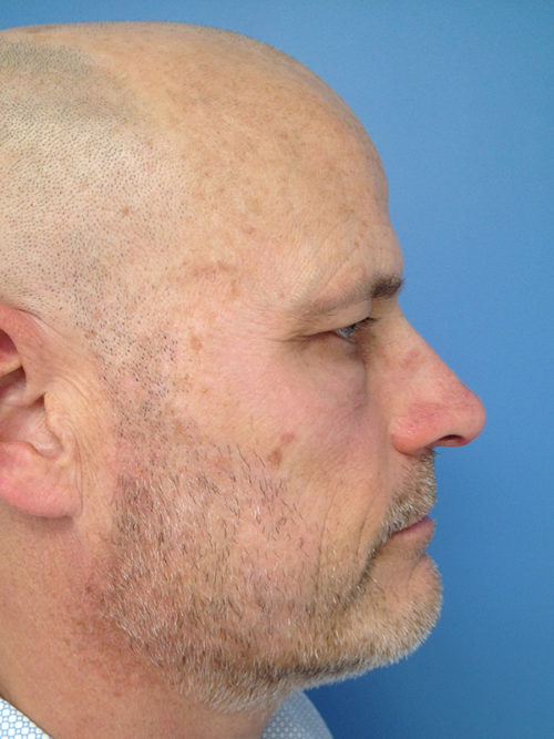 Male Eyelid Surgery