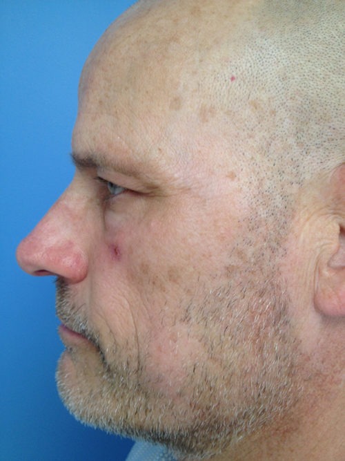 Male Eyelid Surgery