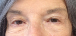 Eyelid Surgery