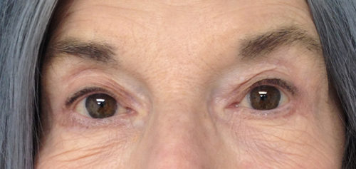 Eyelid Surgery