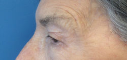 Eyelid Surgery