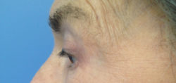 Eyelid Surgery