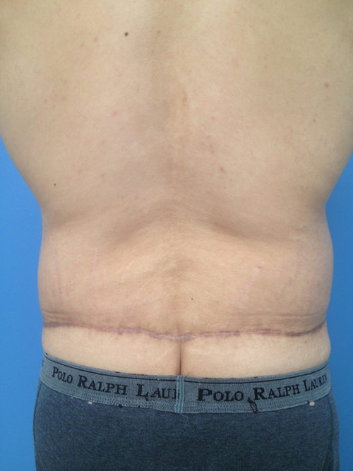 Male Abdominoplasty/Body Lift