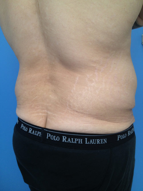 Male Abdominoplasty/Body Lift