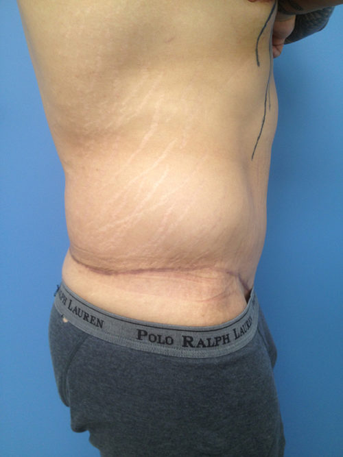 Male Abdominoplasty/Body Lift