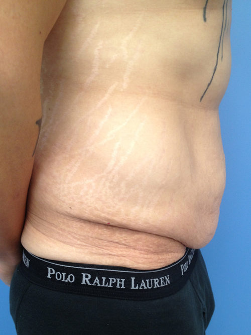 Male Abdominoplasty/Body Lift