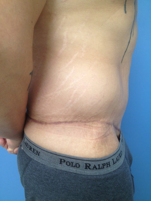 Male Abdominoplasty/Body Lift