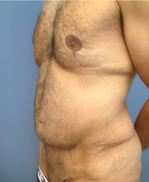 Male Abdominoplasty/Body Lift Case 407 Before Photo Male Abdominoplasty/Body Lift