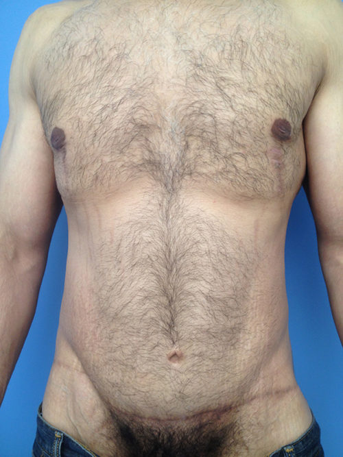 Male Abdominoplasty/Body Lift Case 407 After Photo Male Abdominoplasty/Body Lift