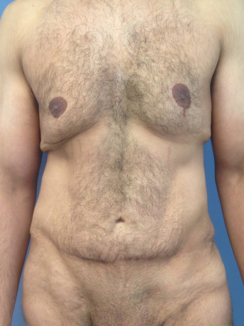 Male Abdominoplasty/Body Lift Case 407 Before Photo Male Abdominoplasty/Body Lift