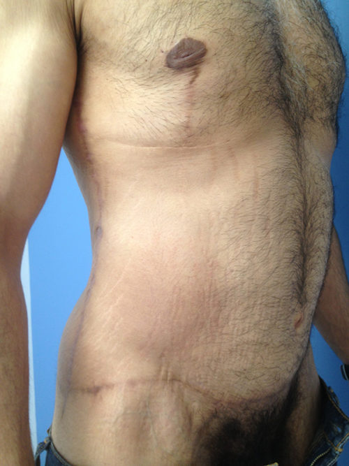 Male Abdominoplasty/Body Lift Case 407 After Photo Male Abdominoplasty/Body Lift